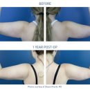 기쁨성형외과의원 | [압구정 일공공성형외과]위고비·마운자로 다이어트 후 팔뚝이 ‘박쥐 날개’처럼 변했다면?