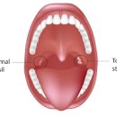 편도결석 구취 입냄새 원인이다 이미지
