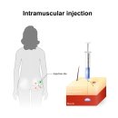 남동간호학원 | 남동간호학원 IV/IM 특강 후기, 주사 공포증 극복한 리얼 경험담