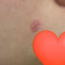 지로한의원 | [안양] 피침 요법 튀어나온 볼록 점 제거 후기 (켈로이드 피부 1년 후 모습)