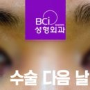 비씨아이성형외과의원 네이버블로그