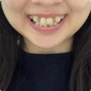 매봉(1) | 매봉역치과 이빨 교정 비용 1도 안아까운 후기 (1년10개월 경과)