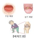 베체트 병 (Behcet's disease) 이미지