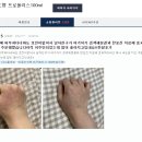 한포진이 많이 좋아지고 있네요!! (사진첨부) 이미지