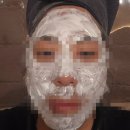 천호동 피부과 점제거(점빼기) 뷰티스카이의원 후기