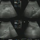 Lt. renal cyst 이미지