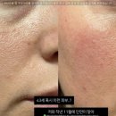 스킨노플(SKINNOPLE) | [스킨노플 홈케어코칭사례] 40대 만성 홍조 & 세로 모공, 근본 장벽 케어로 달라진 실제 변화 사례