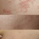 대지약국 | 사타구니 무좀 라미실크림 약국 곰팡이 연고 해결법