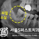서울에스(S)퍼스트치과의원 | 태평동 치과 양쪽 어금니 뿌리 파절로 발치 후 즉시 임플란트 수술! 2개월 완성!
