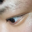 성모하늘빛안과내눈건강식품 | 부산 안검내반 수술 (속눈썹 찔림) 해운대 성모안과 수술비 알려드려요