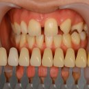 동백서울유치과의원 | 기흥치과 라미네이트 잘하는곳 선택 TIP