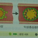 간암이란? 이미지