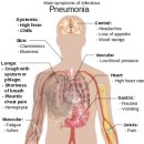 Pneumonia 이미지