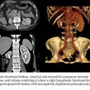 3 Hypoplastic functional kidney 이미지