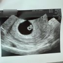 (주)미주코리아 | 자궁내성장지연, 저체중아 의심아기 | 임신 중 자라난 기록 모음