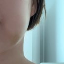 사랑니톡앤턱 | 매복사랑니 발치후기 (feat. 망포 사랑니톡앤턱치과)