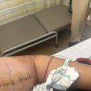 엄마손빨래방 | 안와골절/비골골절/광대뼈골절/상완골 골절/이석증/복시 몸이 다 박살난 오토바이 사고 이야기 및 후기 [3]