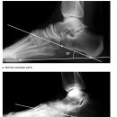 족궁(arch of foot)에 대한 논문 - 수련의 몫 이미지