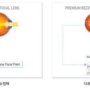 노안을 렌즈로 교정한다? 인공수정체삽입술 이미지