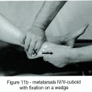 (2일차)실습-Cuboid+MP,Calcanus+Cuboid traction manipulation(2가지) 이미지