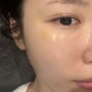 광교여드름관리 꼼에스테틱 수원점 수분 진정 후기