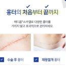 굿팜 | 전이개누공 수술 비용 공개! 실비 처리부터 후관리까지 내가 직접 해본 후기