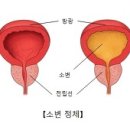 소변정체 (Retention of urine) 이미지