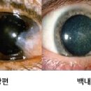 아이안과광주 네이버블로그