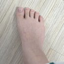 주식회사 엄지 | 케어풋 무지외반증교정기 후기, 엄지발가락교정기 2주 사용후기