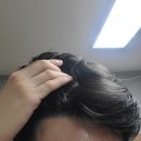 다나성형외과 모발이식 수술 3년 후기 &amp; 지인할인 받는법