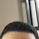 헤어로의원 | 30대 남자 헤어라인 모발이식 용닥터의원 내돈내산 후기 2탄
