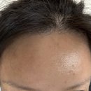 흑자헬스장 | 리쥬란 스킨보톡스 필러 흑자제거 피코레이저 인모드 슈링크 온다 후기