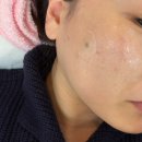 콜드플라즈마 | [대구/중구] 플라즈마 에스테틱 / 대구 콜드 플라즈마 시술 솔직 후기