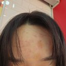 베드로약국 | 얼굴 편평사마귀 제거 상세 후기, 1~3일차 관리 방법