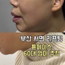 최한의원 | 부산 서면 튠페이스 잘하는 곳 60대 엄마 이중턱 리프팅 후기