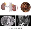 낭성 신장 질환 (Cystic kidney disease) 신장 비뇨기질환이란? 이미지