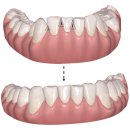 빛날빈치과의원 | [문정동 치과] 교정 후 생긴 '블랙 트라이앵글', 심미적 완성도를 높이는 법