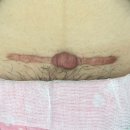 김형섭 | 제왕절개 지렁이 켈로이드 흉터 제거 수술 후기