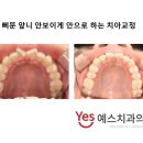 예스안치과의원 네이버블로그