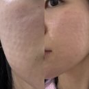 손**-6 | 부산쥬베룩스킨부스터 6cc 손주사 후기, 모공·팔자 고민이라면 꼭 봐야할 리얼 후기