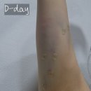 [신논현 피부과/바이슈의원] 워킹맘의 팔뚝살 지방분해 주사 1회차 후기