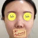 [넓은코성형] 예롬성형외과 코성형, 자연스러운 변화로 만족한 후기