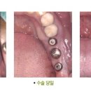 특수임플란트[임플란트 클리닉]-[특수임플란트]`획기적인 특수임플란트 시술방법` 강남치과,치아성형/잇몸성형/미백/미백클리닉/임플란트/심미임플란트 이미지