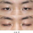 강남서연성형외과의원 네이버블로그