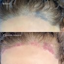 퍼시픽의료기기 | [선릉역] 마리엘뷰티 강남점 헤어라인 문신 SMP 제거 후기