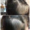 [부산사상 르네시떼 미용실] 탈모 고민 끝! 정밀 두피 관리부터 마법 같은 커버 스타일 펌까지 이미지