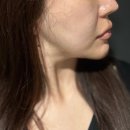 내돈내산 n회차 최애 티타늄리프팅 60kj + 튠라이너 30kj 솔직후기 / 유지기간 강남 압구정 잘하는곳