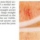 반월판(meniscus)의 혈관분포 이미지