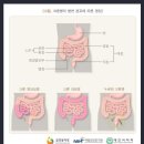 갱신형 특정4대소화계질환 (충수·복막·기타장질환)진단비보장 특별약관 (특정4대소화계질환(충수∙복막∙기타장질환)의 정의 및 진단확정 이미지