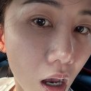 색소침착 피부과 레이저 안 받고 없애는방법?